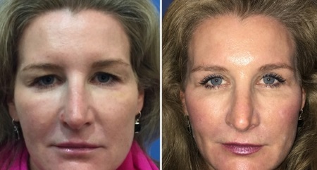 blepharoplastie Turquie avant apres