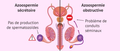 biopsie testiculaire 