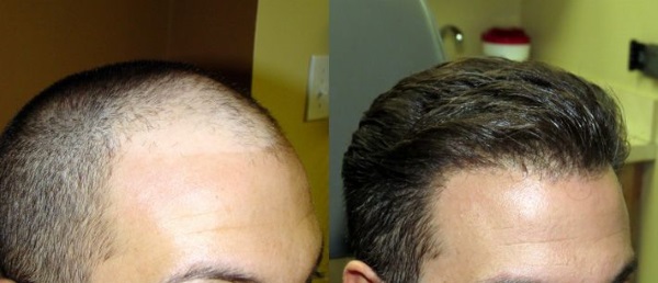 greffe cheveux avant apres