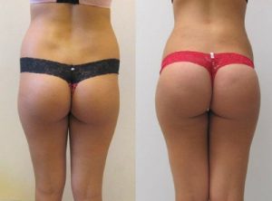 lipofilling fesses turuqie avant apres