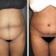 plastie abdominale avant apres