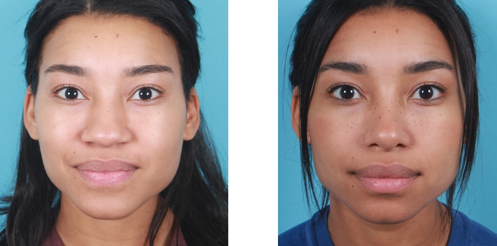 rhinoplastie medicale gros nez