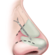 implant nasal