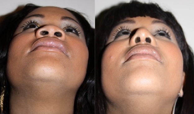 chirurgie nez afro americain avant apres