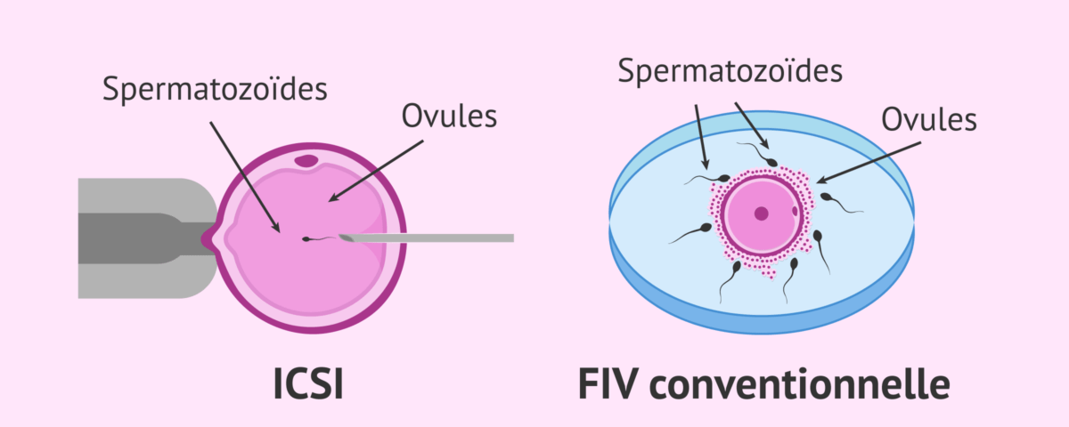 fiv icsi