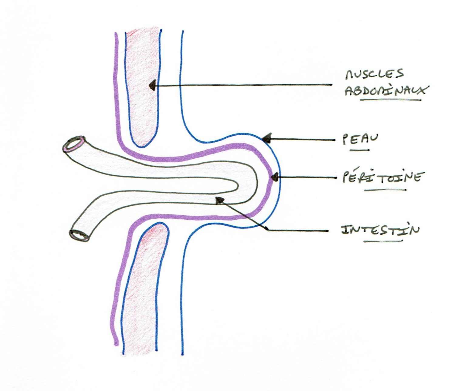 Quelle est la différence entre une hernie ombilicale et un diastasis