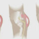 implant fessier retrait
