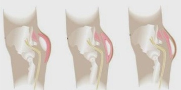implant fessier retrait