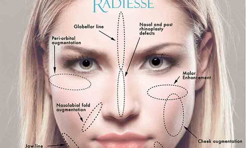 radiesse ovale du visage