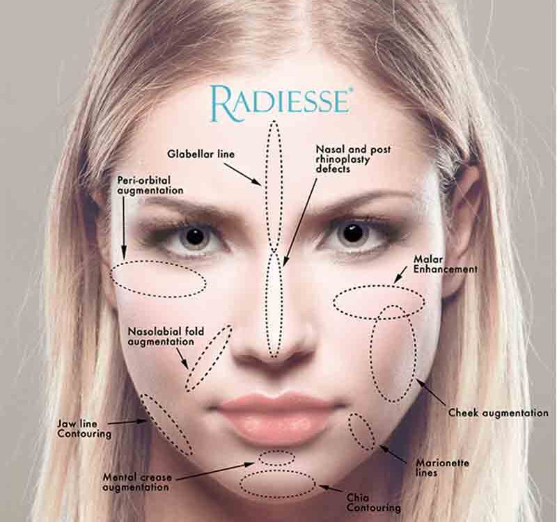 radiesse ovale du visage