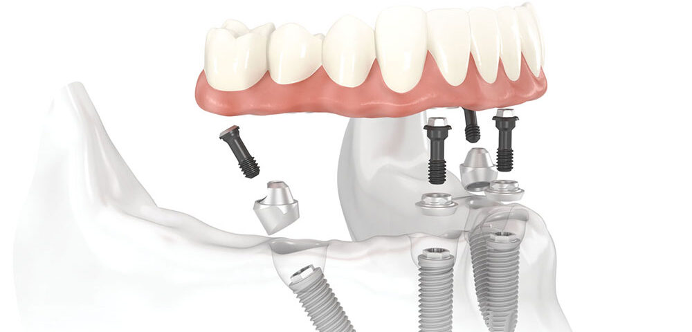all on 6 implant turquie
