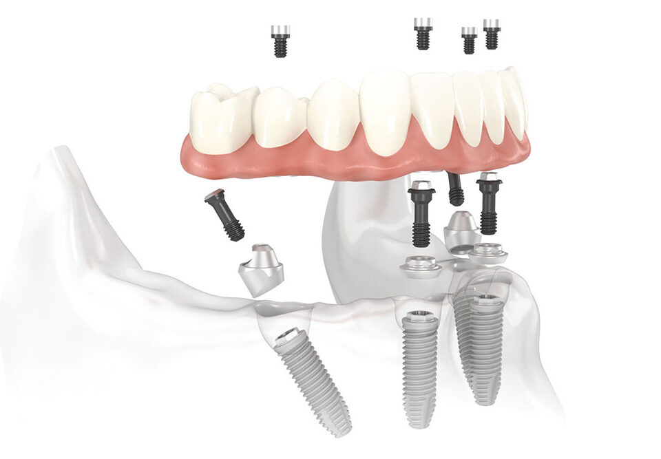 all on 6 implant turquie