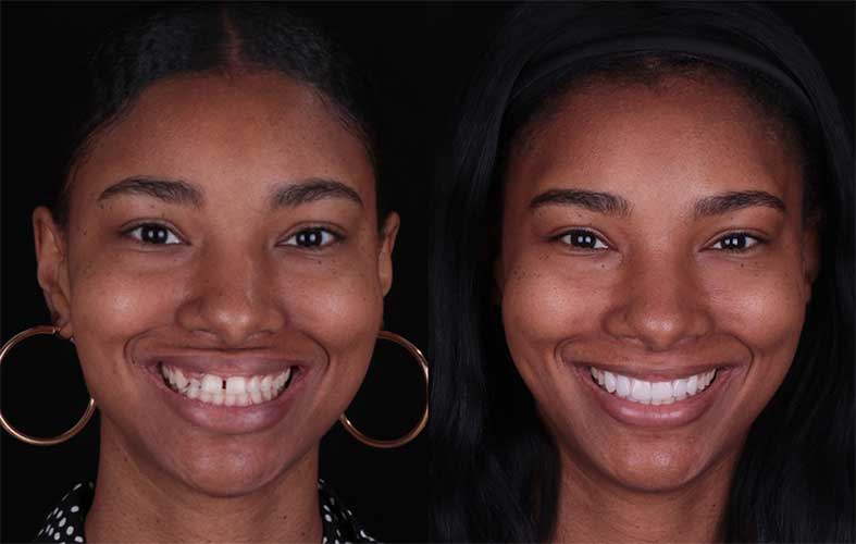 smile makeover turquie avant apres